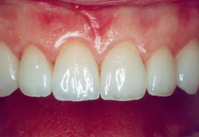 After Veneers