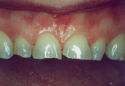 Before Veneers