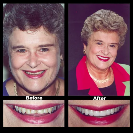 Smile Makeover – Case 1