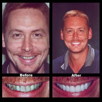 Smile Makeover – Case 2